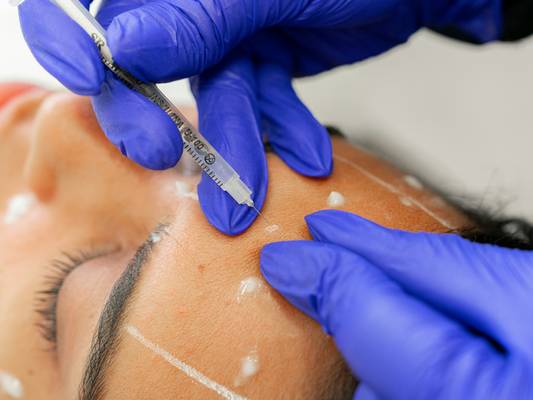 Zbliżenie na zabieg wstrzykiwania botoksu w czoło – artykuł o naturalnych sposobach na młodą skórę bez botoksu